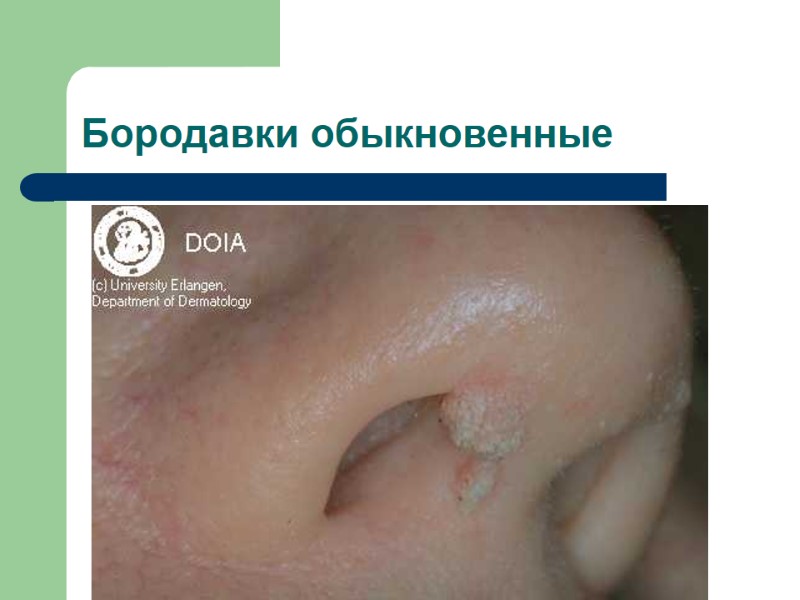 Бородавки обыкновенные